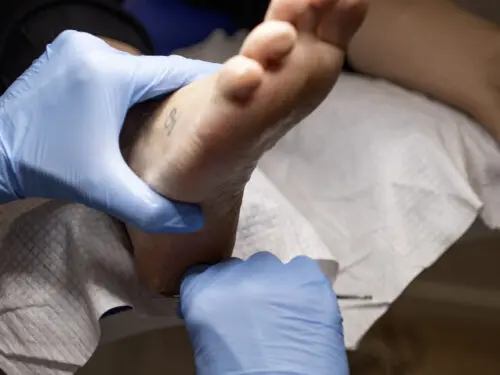 Fodbehandling med Shellac ved fodplejer Lisbeth Reksle